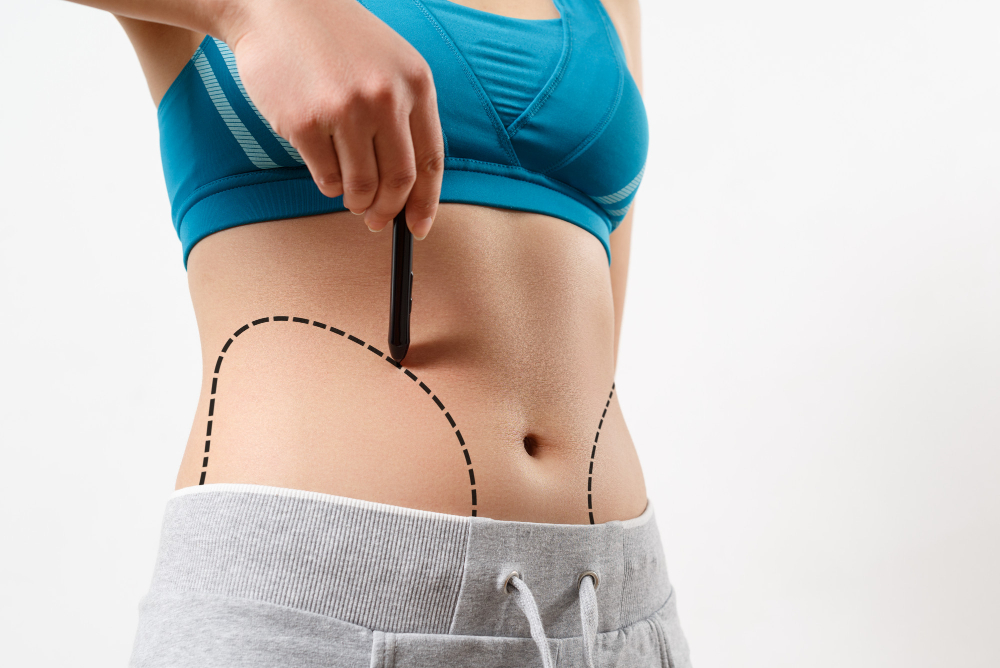 woman-shows-dotted-line-her-body-liposuction-zone.jpg