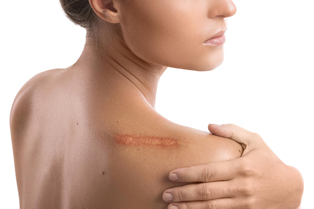 woman-with-scar-her-shoulder-white-background.jpg