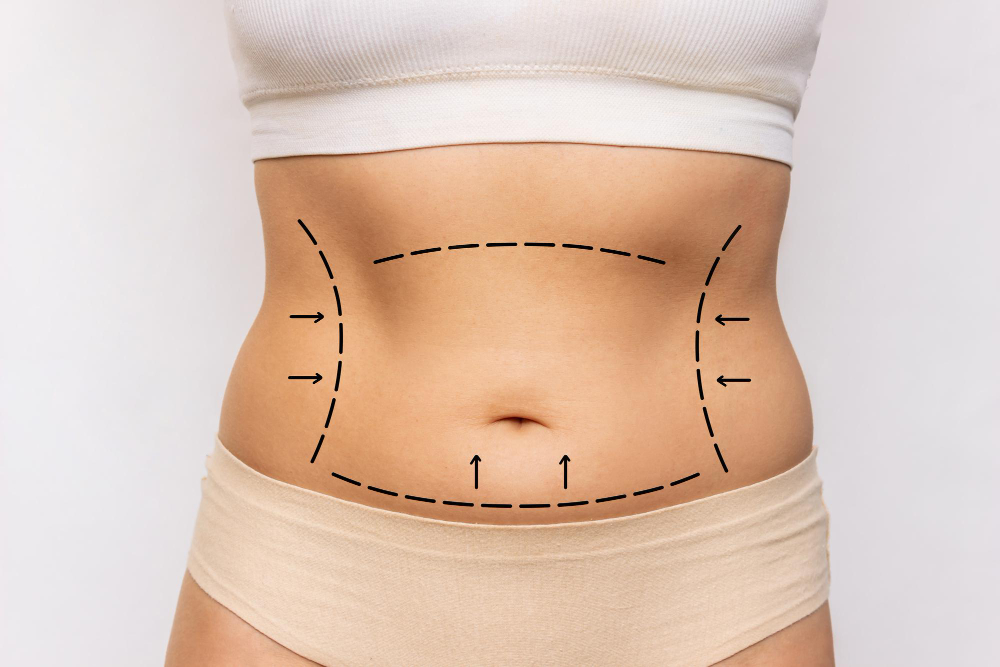 closeup-womans-belly-with-excess-fat-with-marking-her-body-liposuction-plastic-surgery.jpg