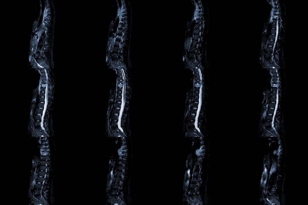 mri-thoracic-spine-sagittal-history-back-pain-with-compression-fracture-t9-medical-education-concept.jpg