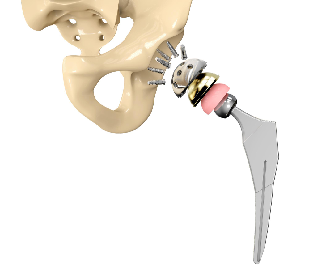 3d-illustration-hip-replacement-implant-installed-pelvis-bone.jpg